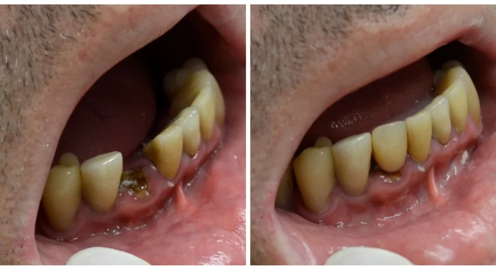 Čo Sú Zubné Implantáty S Okamžitým Zavedením? Postup A Ceny