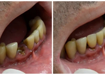 Co Jsou Zubní Implantáty Zavedené Během Jednoho Dne? Postup A Ceny