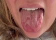 Burning Mouth Syndrome: Treatment, Causes, Relief & Symptoms