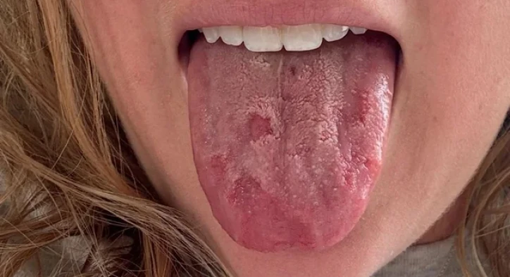 Burning Mouth Syndrome: Treatment, Causes, Relief & Symptoms