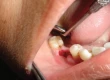 Dry Socket: Symptoms, Treatment, Causes & Healing