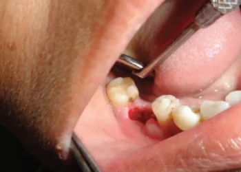 Dry Socket: Symptoms, Treatment, Causes & Healing