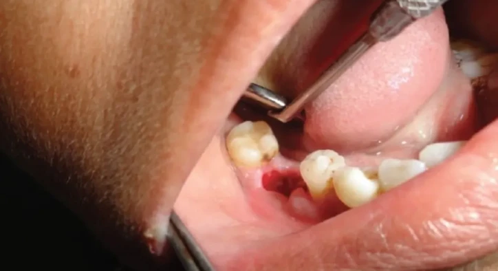 Dry Socket: Symptoms, Treatment, Causes & Healing