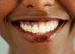 Zahnfleisch-Hyperpigmentierung: Behandlung, Ursachen & Laser