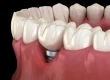 Periimplantitida: Léčba, Fáze, Symptomy A Laserová Terapie