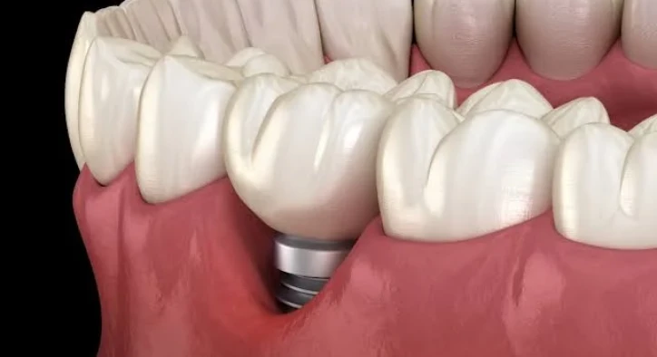 Periimplantitida: Léčba, Fáze, Symptomy A Laserová Terapie