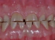 What Is Tooth Attrition? Causes & Treatment Options
