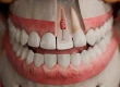 Zahnwurzelresorption: Symptome, Ursachen & Behandlung
