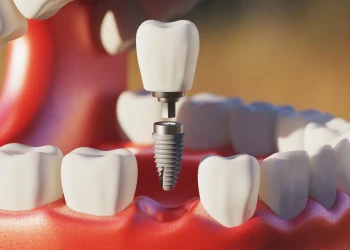 Mini Zubný Implantát: Cena, Typy A Porovnanie S Bežnými