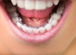 Lingual Braces: Cost, Overbite, Results & Vs Regular Braces