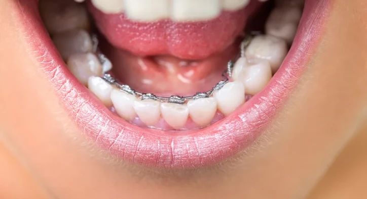 Lingual Braces: Cost, Overbite, Results & Vs Regular Braces