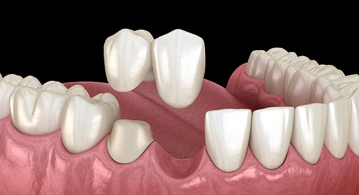 Cantilever Bridge Teeth: Uses, Longevity, Cost & Front Teeth