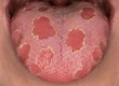 Geographic Tongue: Symptoms, Causes, Diet & Treatment