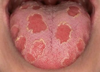 Geographic Tongue: Symptoms, Causes, Diet & Treatment