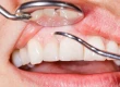 Gum Bleaching: Laser Depigmentation, Costs, Pain & Before After