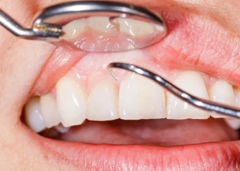 Gum Bleaching: Laser Depigmentation, Costs, Pain & Before After