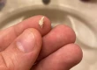 Bone Spur After Tooth Extraction: Causes, Pain & Removal