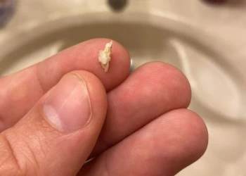 Bone Spur After Tooth Extraction: Causes, Pain & Removal