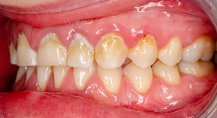 Calcified Tooth: Causes, Symptoms, Root Canal & Saving Teeth