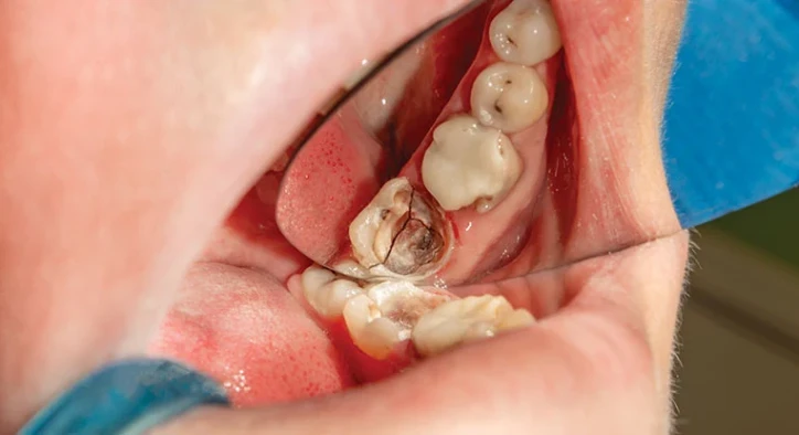 Chipped Molar: Causes, Repair Options, Costs & Pain