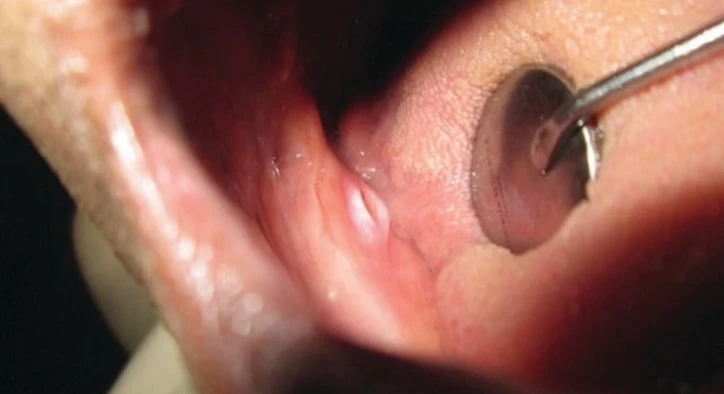 Denture Sores: Causes, Stomatitis Relief & Fast Healing