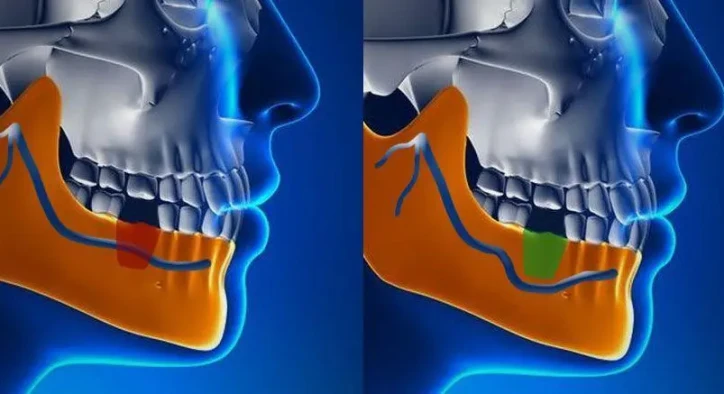 Poškodenie nervu po implantáte: Príznaky, príčiny a liečba