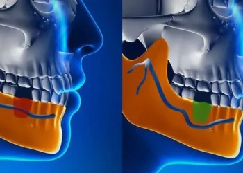 Poškození nervu po zubním implantátu: Příznaky a léčba