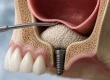 Rekonvalescence po sinus liftu: Doba hojení, bolest a péče