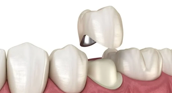 Dočasná korunka: Čo robiť ak vypadla, bolesť a starostlivosť