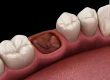 Tooth Extraction Clot: Healing Stages, White Tissue & Care
